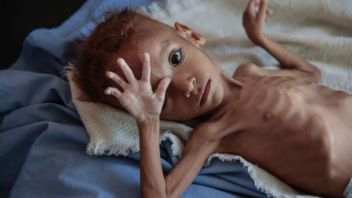 Hunger and Starvation Affecting Half the Human Race Across the World